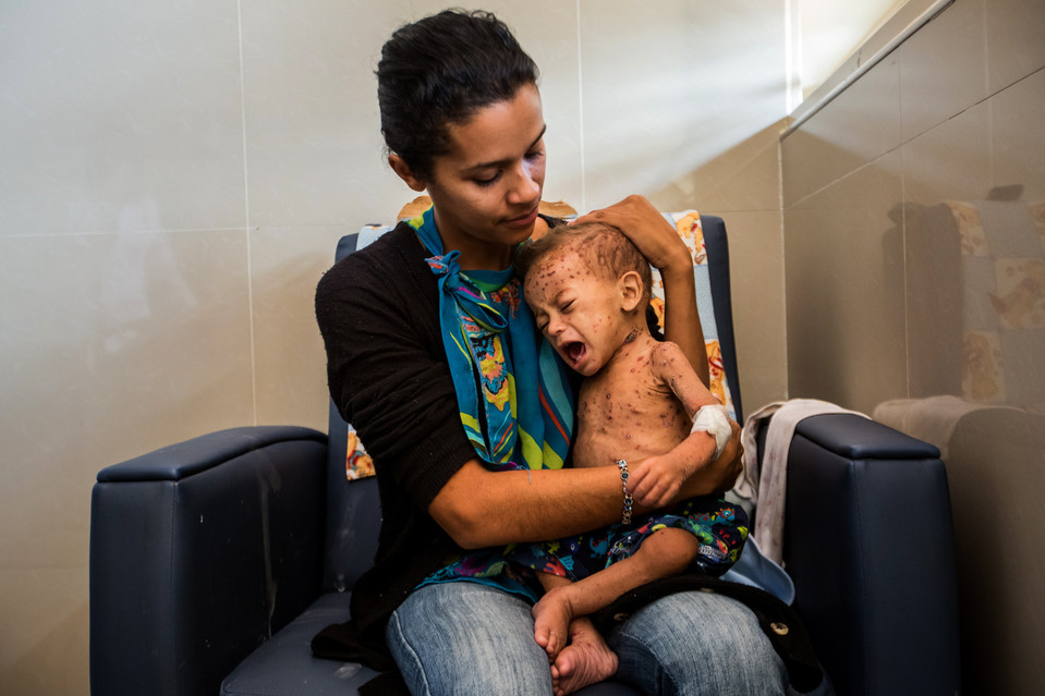 加拉加斯的一家医院内，Maria Planchart抱着一岁的儿子Jean Pierre。这个虚弱的孩子正在从严重的营养不良和水痘中慢慢恢复。